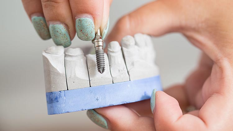 Zwei Hände in Großaufnahme demonstrieren an einem Gipsmodell den Einsatz der Zahnimplantate.